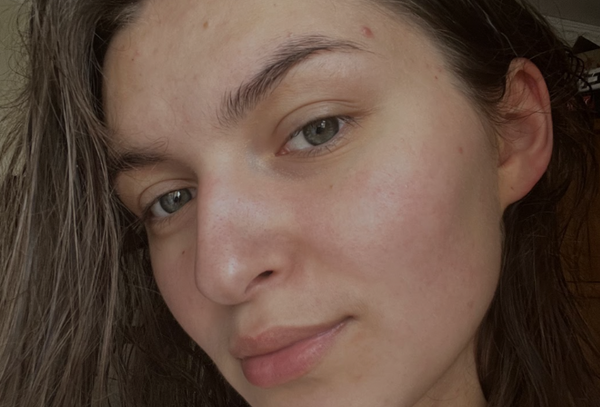 How one skin app has improved my acne and lifestyle